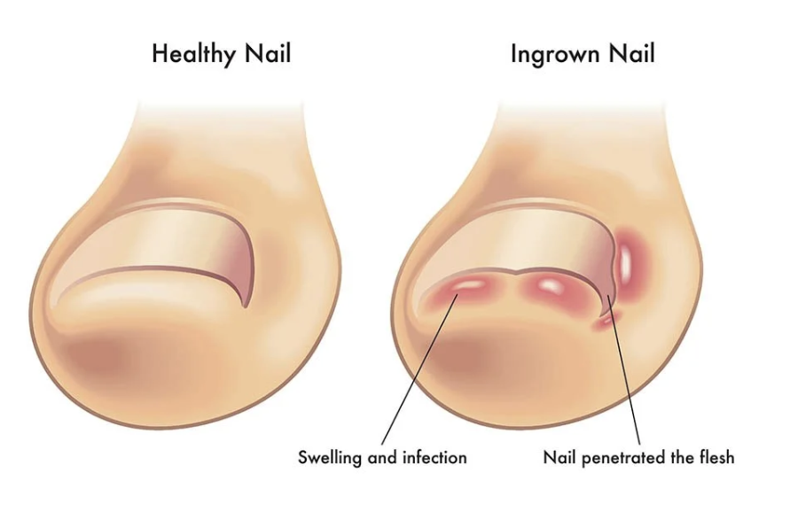 Toenails images, swelling and infection, nail penetrated the flesh