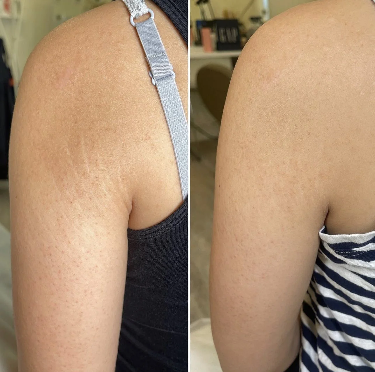 transformation after stretch mark camouflage tattoo