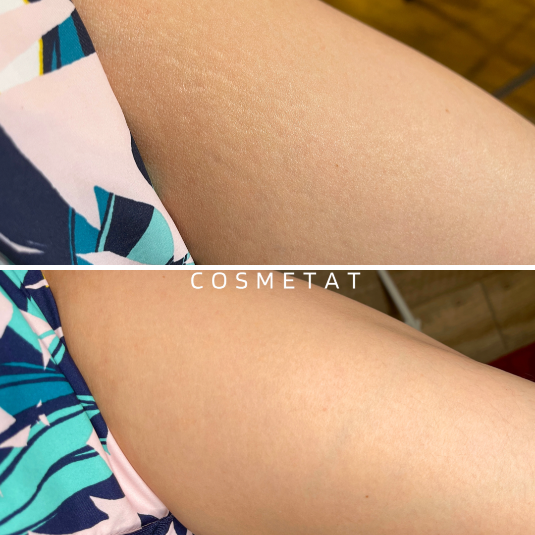 before and after result of stretch mark camouflage on asian skin