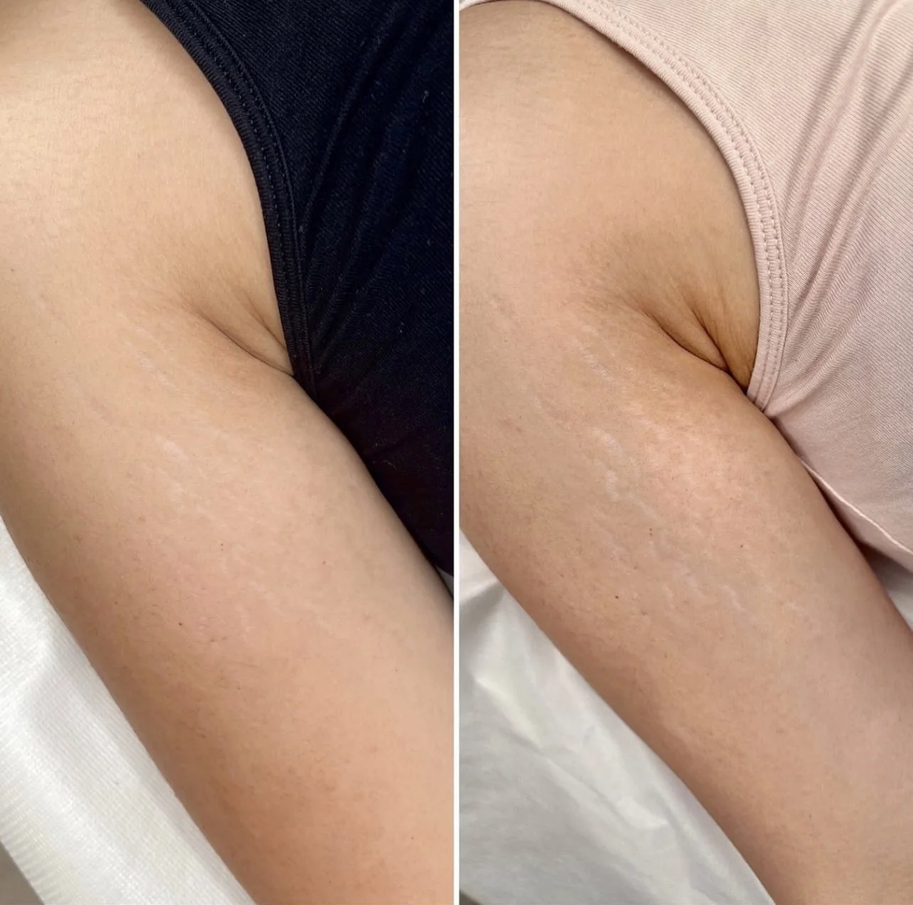 stretch marks removed after camouflage tattoo