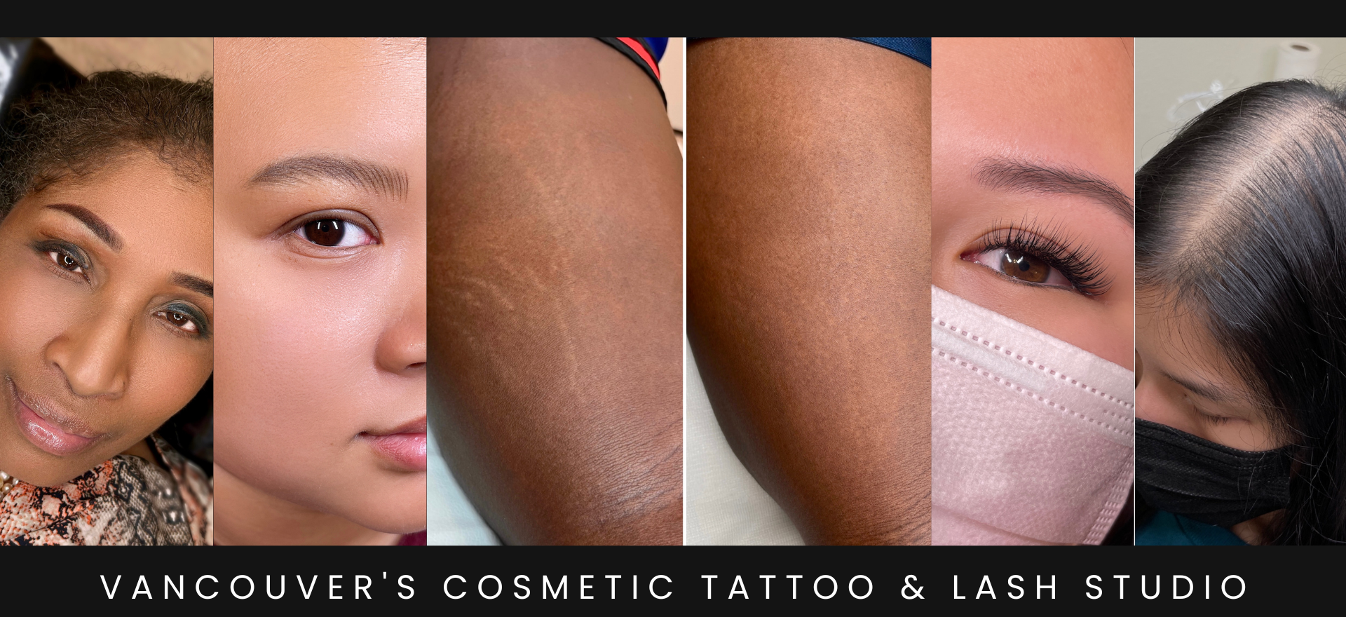 PicoWay Laser Tattoo Removal – Synergy Medical Aesthetics – Nanaimo,  Victoria, Vancouver Island