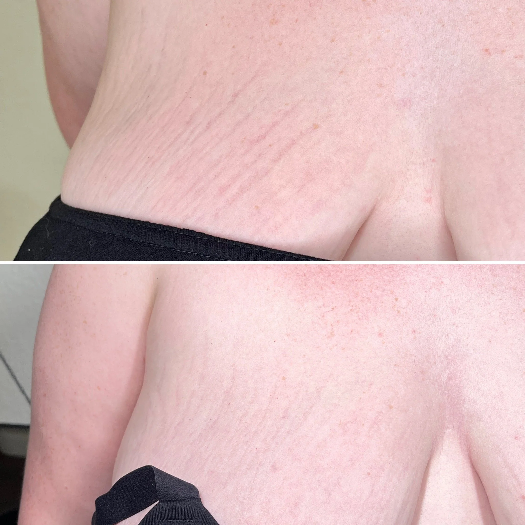stretch-mark-removal-breasts.JPG