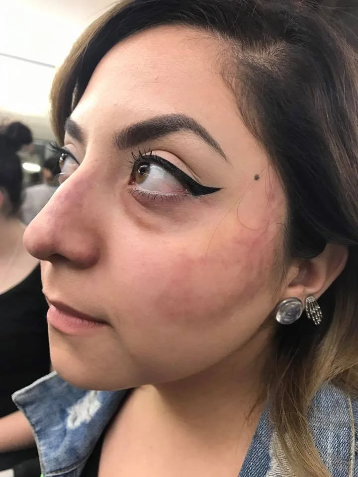 Cheek Bruising.jpg