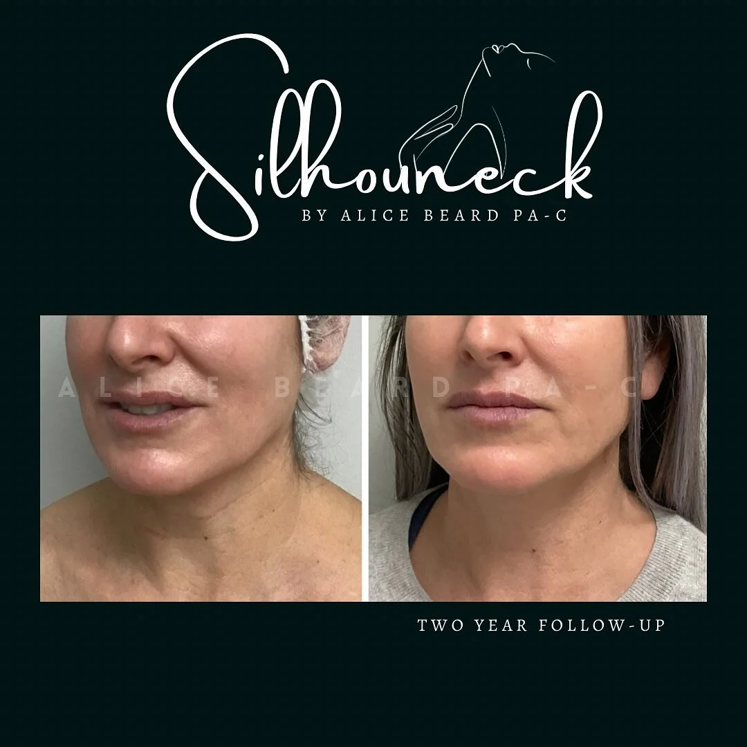&ldquo;Well how long does it last?&ldquo; - This is one of the most common questions we get asked everyday. Here, Alice Beard PA-C delivered incredible and long-lasting results with her customizable treatment system: #silhouneck 📐✔️✨❤️&zwj;🔥

.
.
.