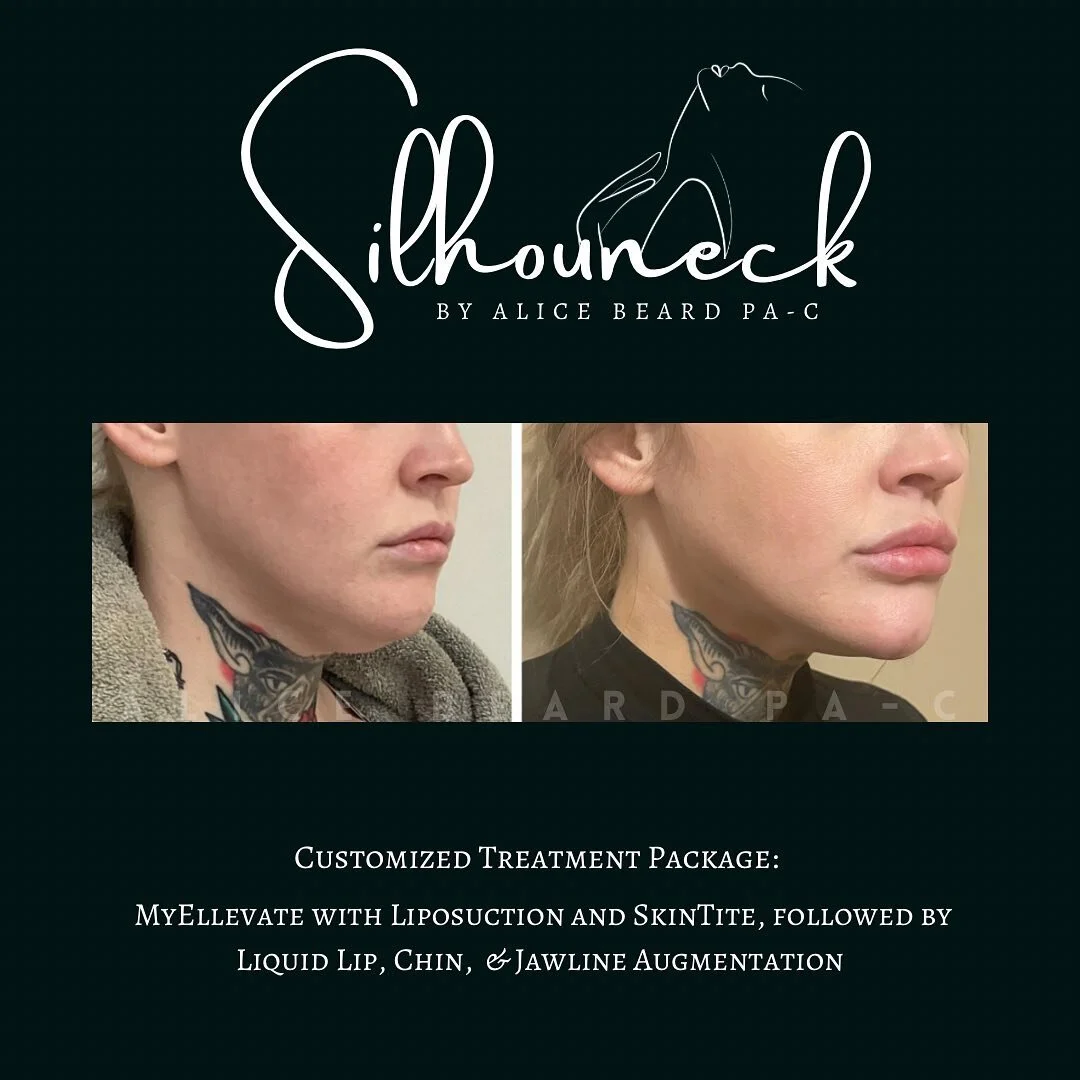 ✨#NonSurgicalNeckLift✨: @silhouneck by Alice Beard PA-C utilizes a number of combined treatment methods to achieve the jawline/neck YOU desire most. Follow our new page for the latest before and afters, BTS footage, and information to create your own