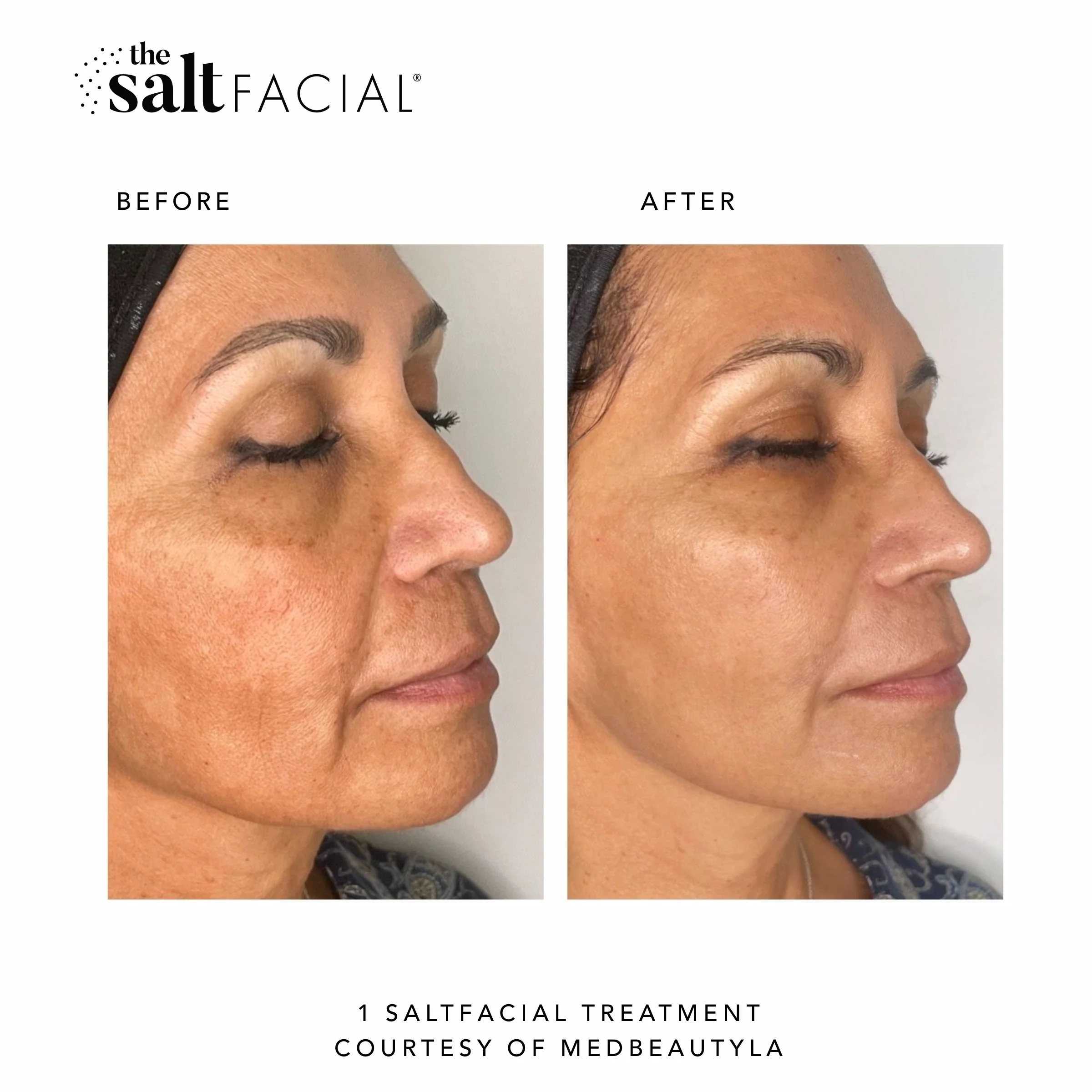 SaltFacial_BeforeAfter21.jpg