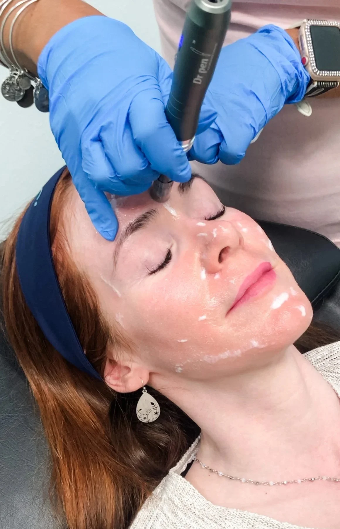 patient receiving a full face microneedling treatment with regenerative therapies