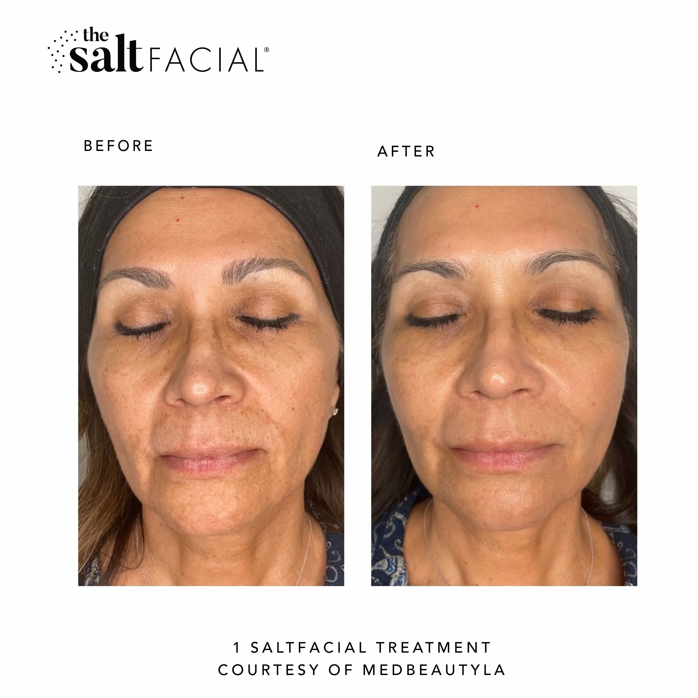 SaltFacial_BeforeAfter20.jpg