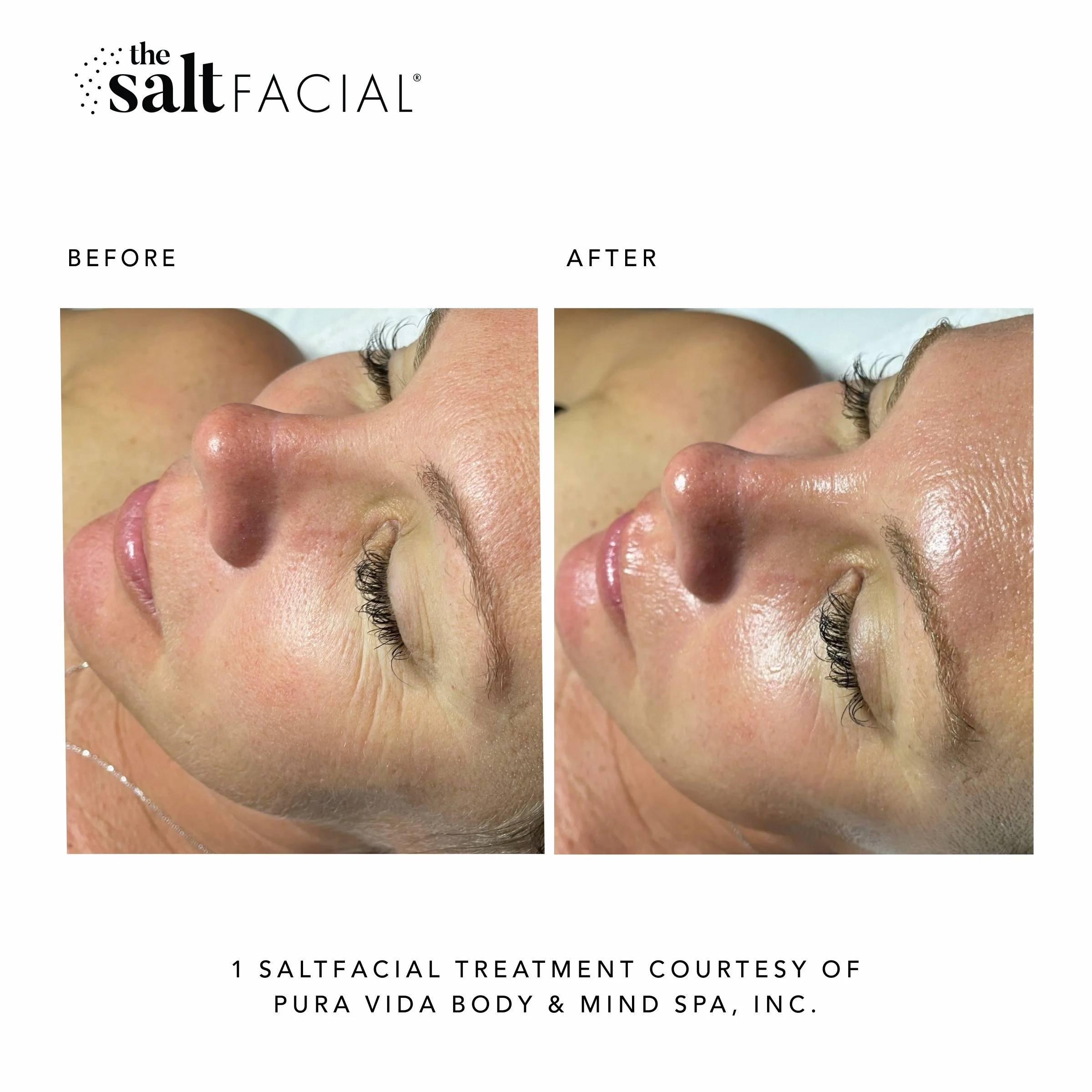 SaltFacial_BeforeAfter22.jpg