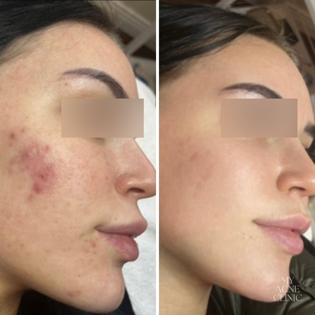 ✨ Before &amp; After Acne Treatment: We love seeing your results! In addition to having clearer skin, many of our clients also have a noticeable improvement in the texture of their skin.⁣

🙋🏼 I'm always happy to chat about your skincare needs! Send