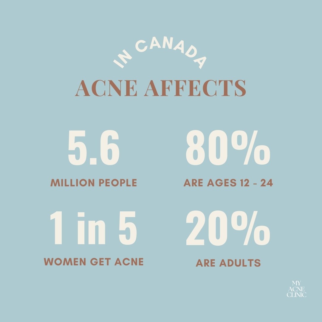 Who gets acne? You are not alone!
Reference: Canadian Dermatology Association

🔸 Acne affects 5.6 million Canadians, close to 20% of the population.
🔸 More than 80% are between ages 12 - 24.
🔸 Acne affects about 90% of adolescents, and 20-30% of a