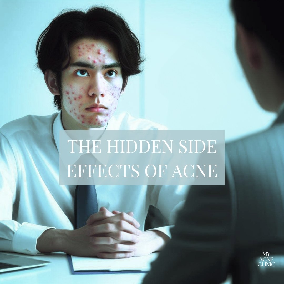 Acne affects more than just the skin; it can have profound implications on daily life, relationships, and career. Have you encountered any of these hidden side effects of acne in your life?

🧔🏽💄 Grooming Challenges: Dealing with acne means even si