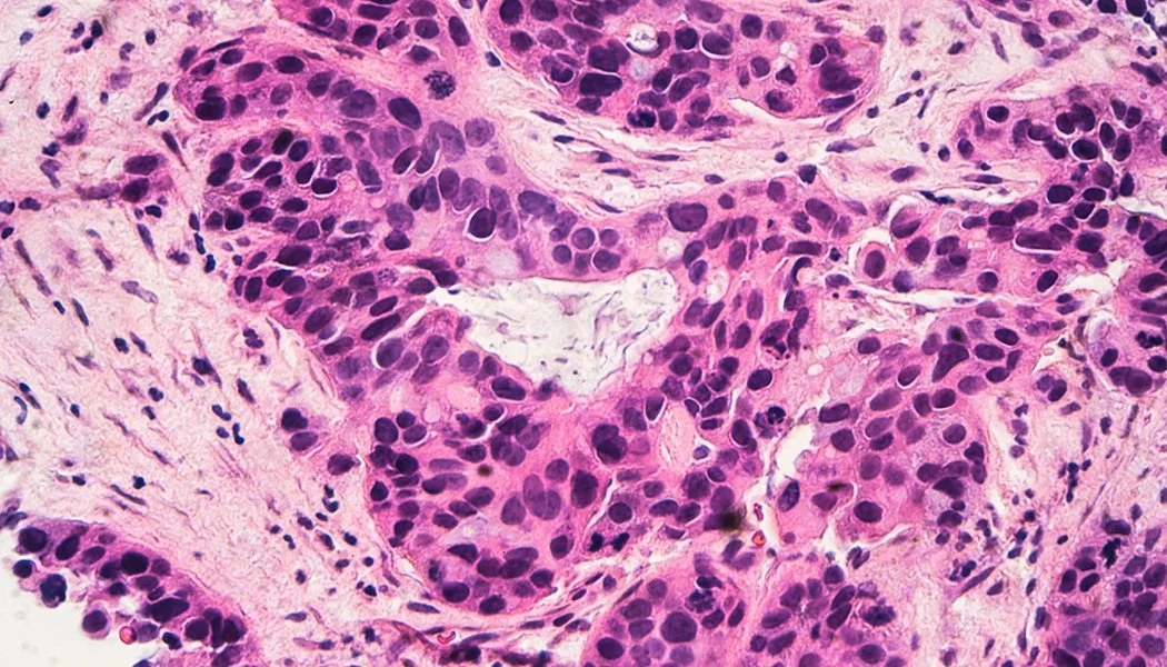 breast-cancer-bone-marrow-ft.jpg