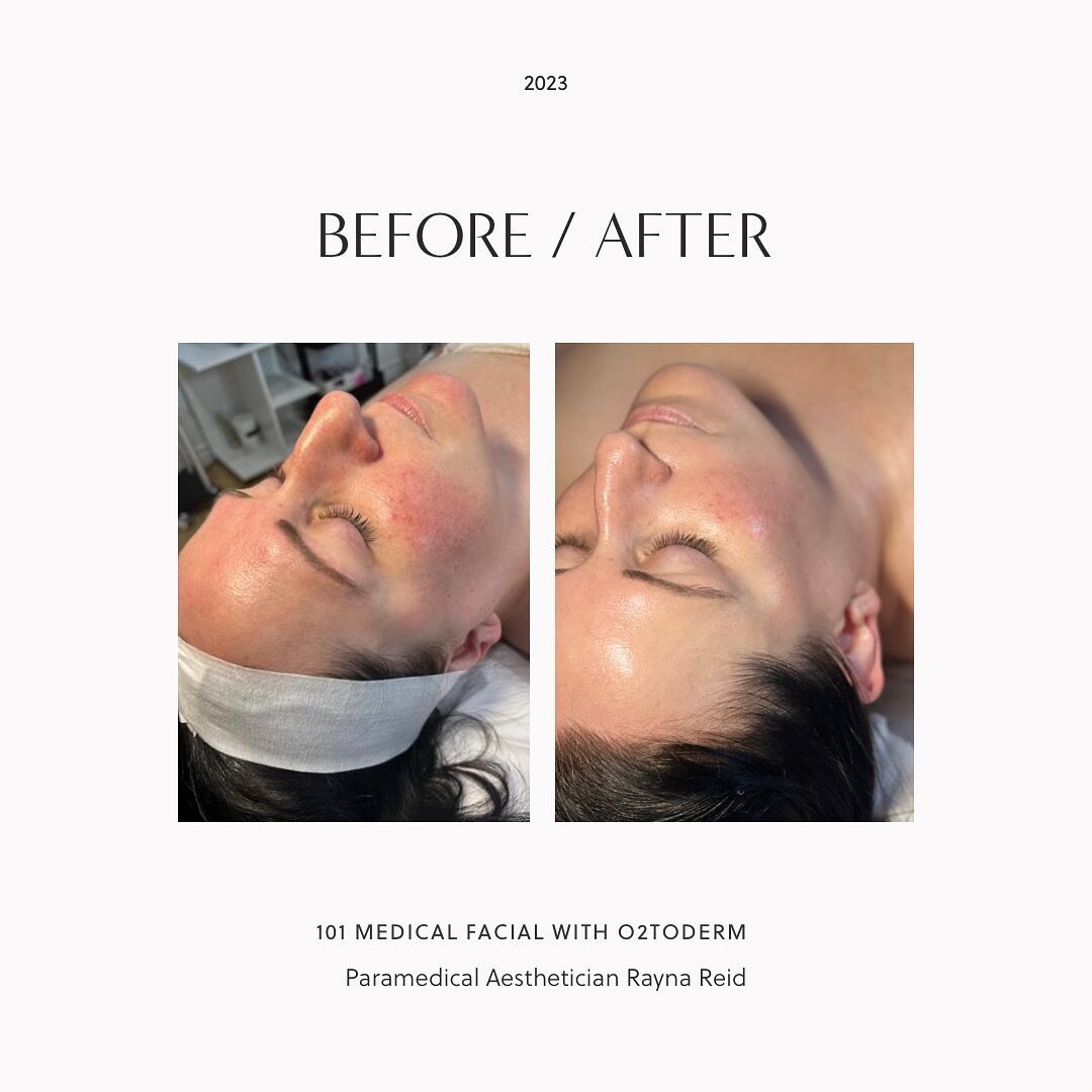 Beautiful results ! Notice the significant decreases in inflammation!! More even tone / hydrated and glass like finish ! Beautiful results from our 101 medical facial / with O2TODERM add on ! DM / visit vibeskin.ca for any inquiries on our luxurious 