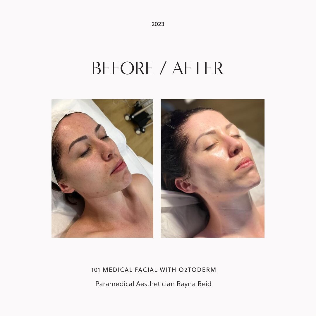 We love a good before and after! Our 101 Medical Facial / Dermaplaning with add on of O2toDERM - peel treatment followed by O2TODERM corrects pigmentation / evens skin tone /revitalizes the skin / hydrated and leaves a Glass finish ! Results directly