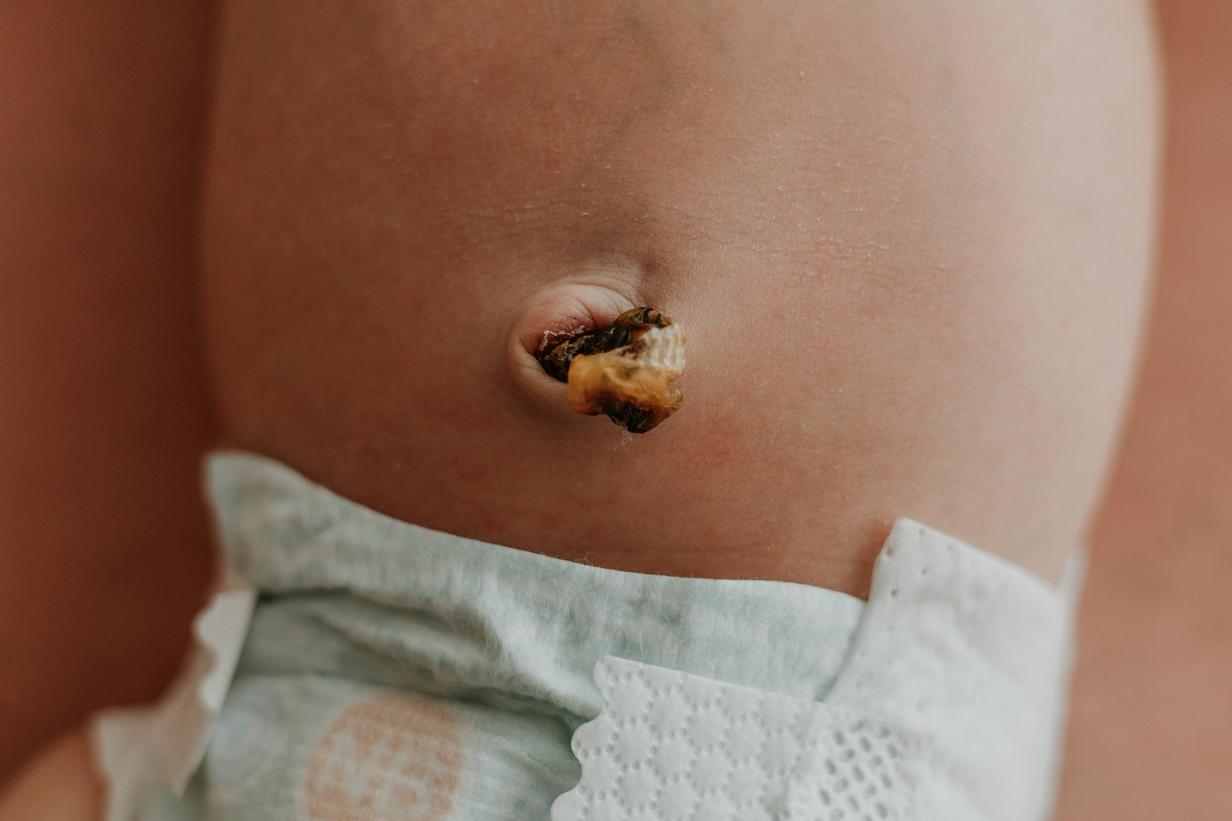 Umbilical cord nearly dried up on a newborn baby.