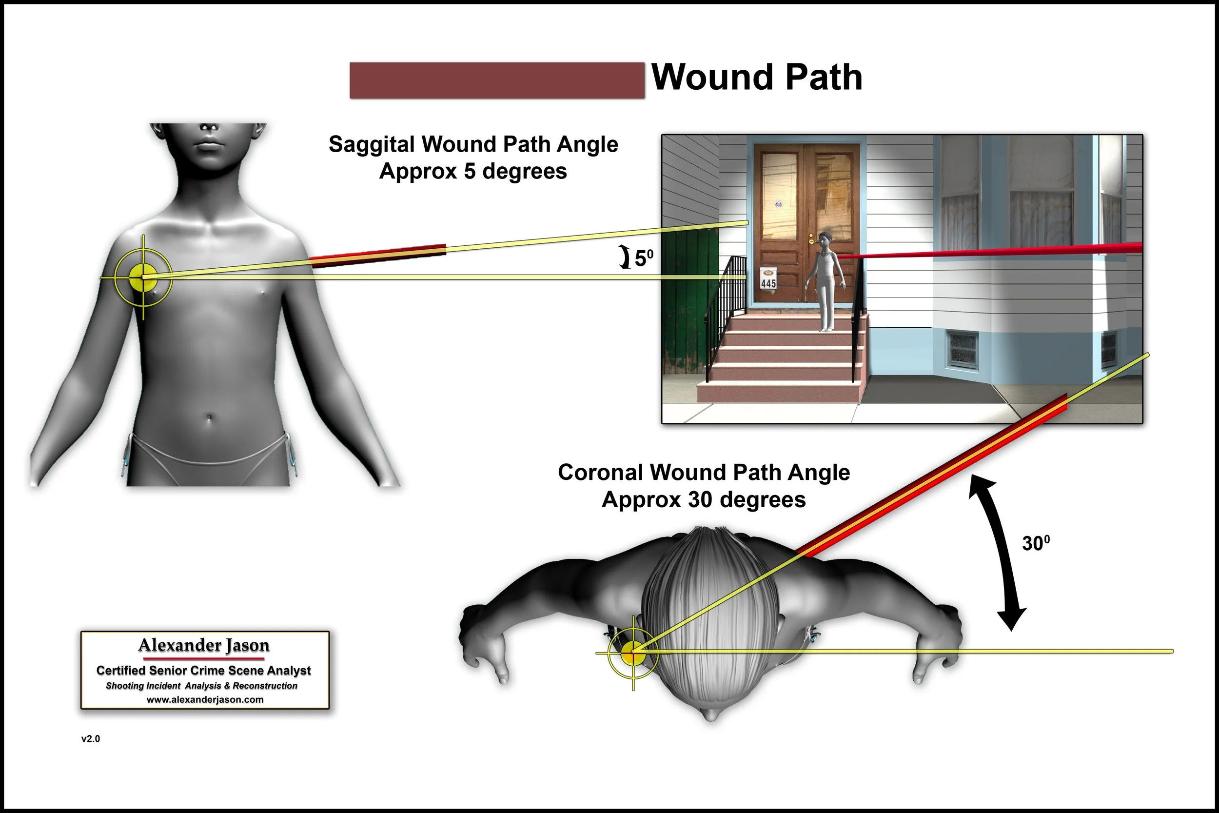 Diagram showing the trajectory of a wound path on a crime scene, including a side view of a woman, an overhead view of a person, and an exterior house scene with a figure on steps. It displays sagittal and coronal wound path angles of approximately 5 and 30 degrees, respectively.