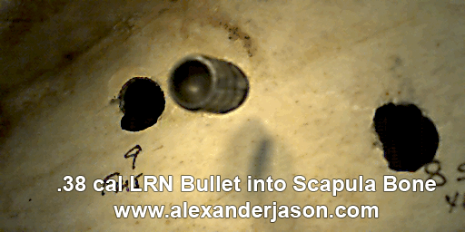 Close-up of a human bone with bullet holes and a .38 caliber bullet inserted into the shoulder blade.