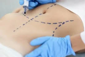 pre-operative education for lymphatic drainage to support cosmetic surgery recovery and results