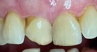 Bonding #6--Before.  This patient lived with her chipped front tooth for years.  When she was offered an opportunity to fix the chip, with the added benefit of addressing the exposed root and mismatched gumlines, she decided to take a leap of faith.