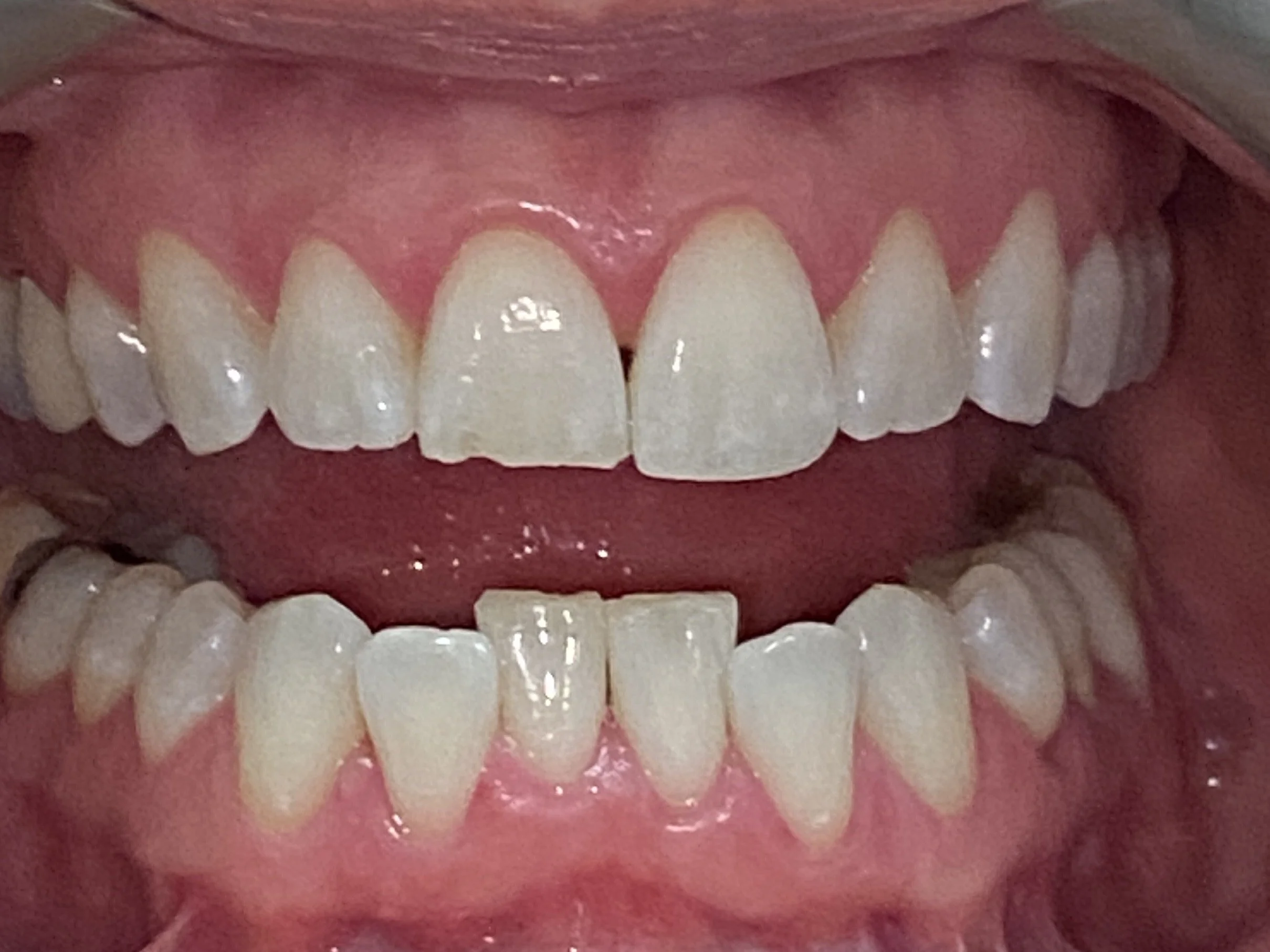 Invisalign #6--Before.    This patient has been waiting a long time to improve her smile.  She disliked the chip on her front tooth and the increasingly crowded lower teeth.  Due to supraeruption, there was not a lot of room to build up the front too
