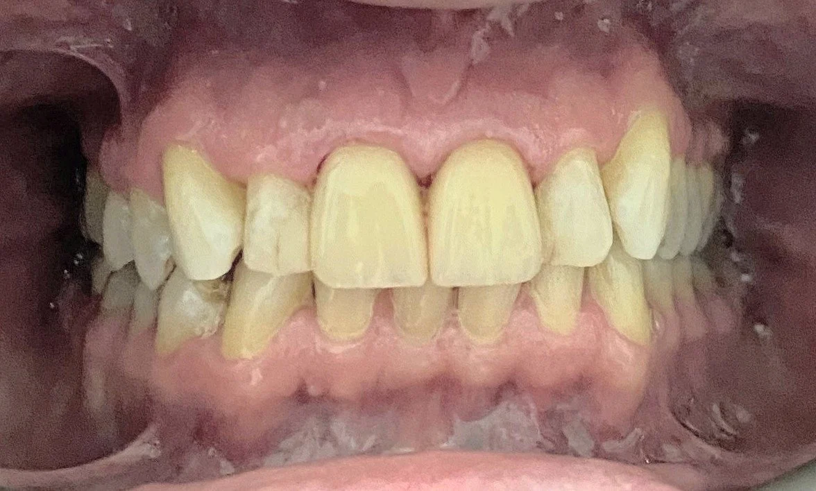 Crowns #4--After.  The improvement is drastic with a more natural looking material, a better matched shade and shape, and the gums are in better health because the margins are properly sealed.  