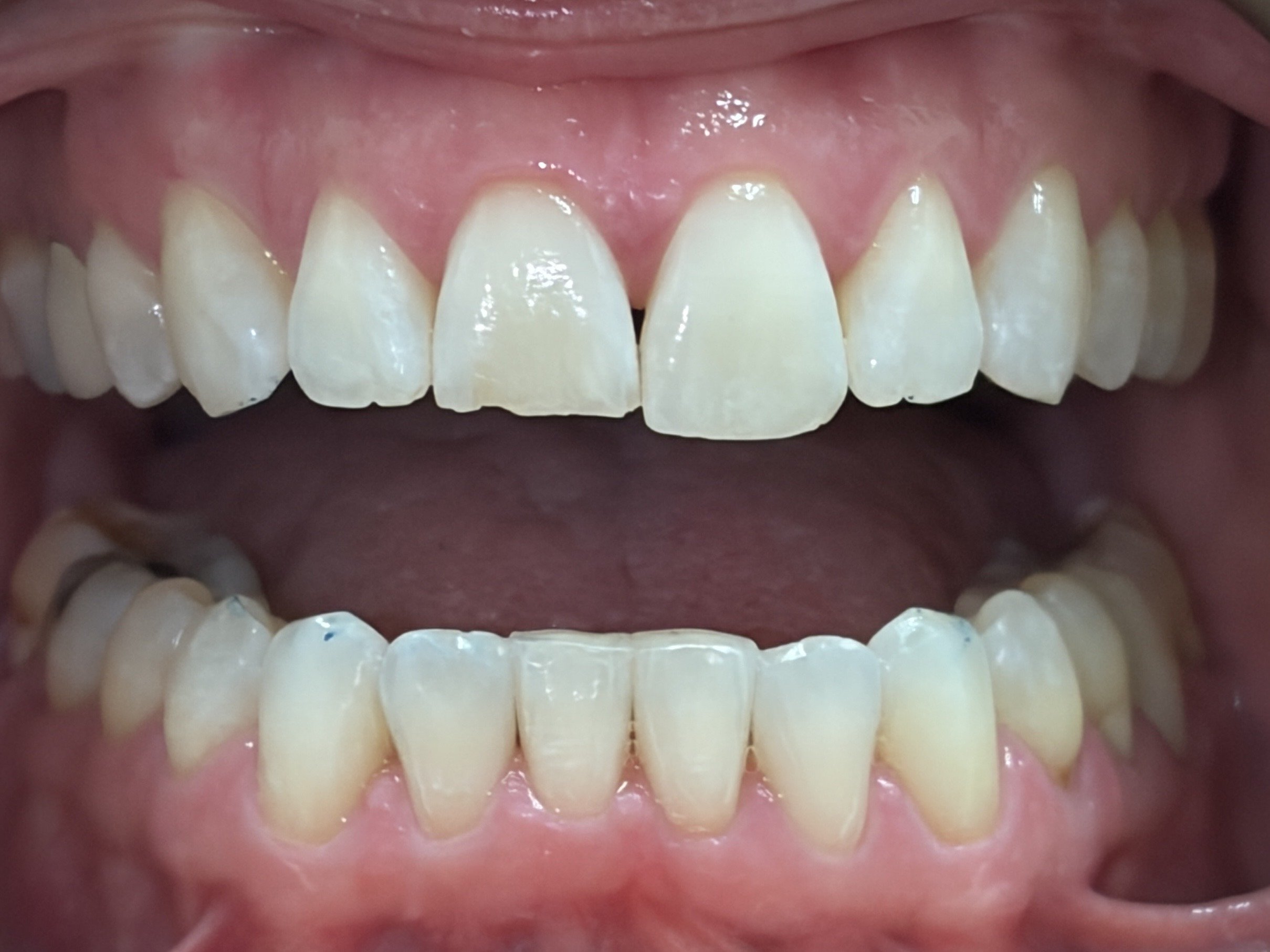 Bonding #7--Before.  Head to the Invisalign section to see how the teeth looked before alignment.  This patient is now ready to have bonding to build up the length of her tooth, which we couldn't do before we made room to do so.