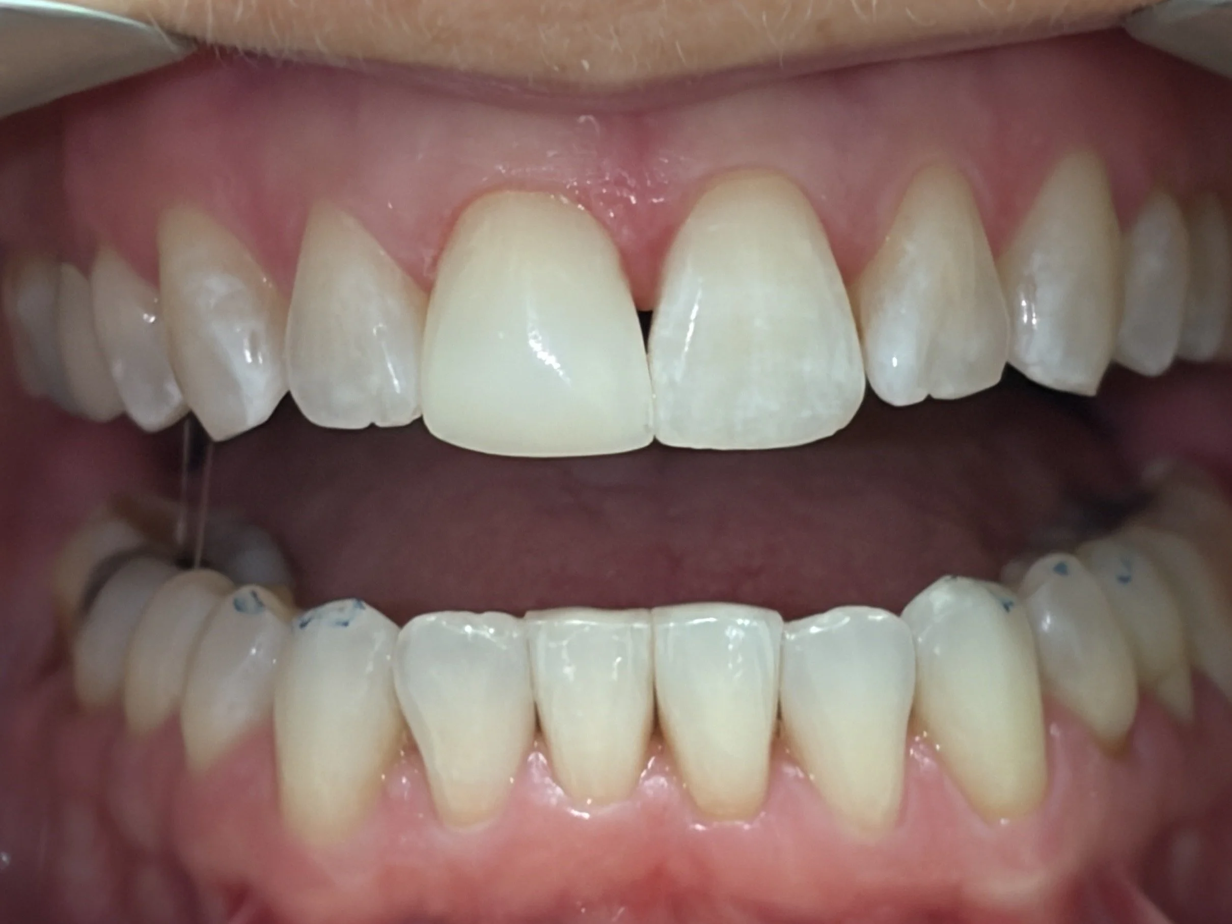 Bonding #7--After.  Using cosmetic bonding, the tooth is back to its full length without interference from the lower teeth!