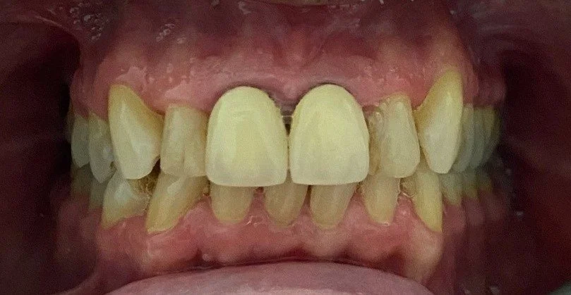 Crowns #4--Before.  The crowns had unsightly dark margins due to the older material used for the crowns.  The shapes were also not harmonious with the surrounding teeth, and the shade and opacity were too much of a contrast.  Lastly, bacterial accumu