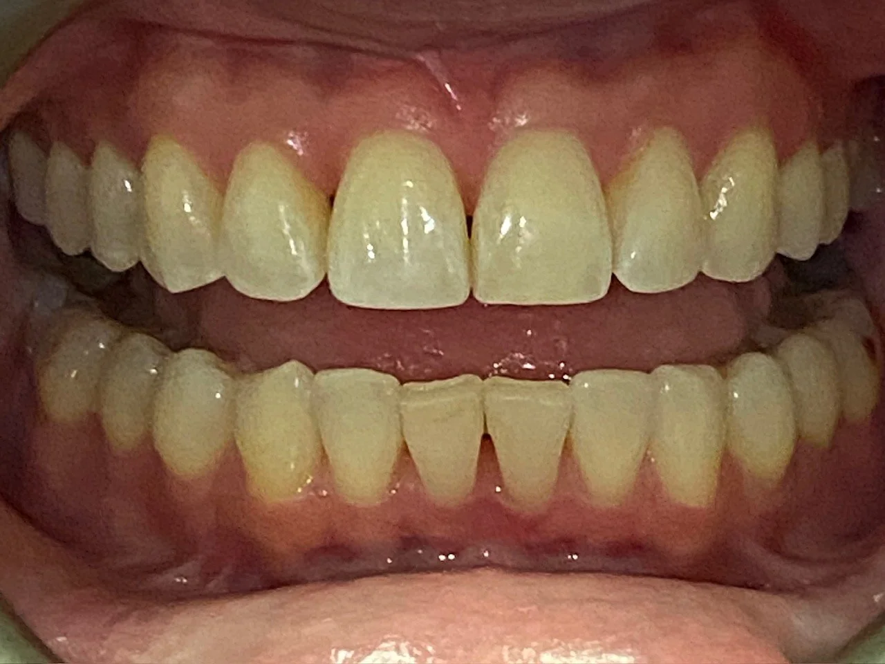 Invisalign #5--After.  She was initially given a comprehensive orthodontic plan, but ultimately decided what mattered most to her was how her front teeth looked.  In the end, even with limited treatment, the result improved her alignment significantl