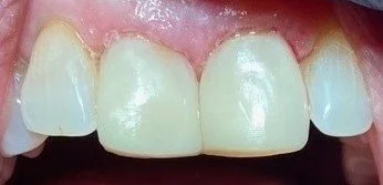 Bonding #6--After.  With proper symmetry in the proportion of the teeth and harmony with the gums, this patient couldn't be happier with the final result.