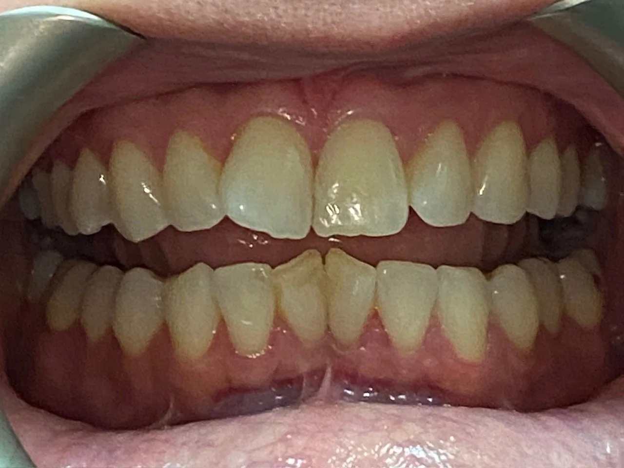 Invisalign #5--Before.  This patient was always self conscious of her smile due to the rotated central incisors.  