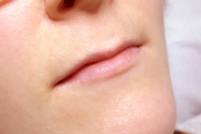 lippen-vorher.jpg