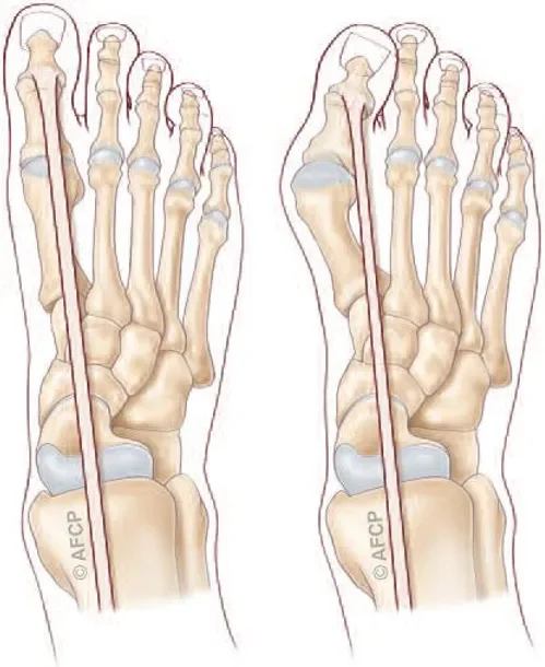 Hallux Valgus