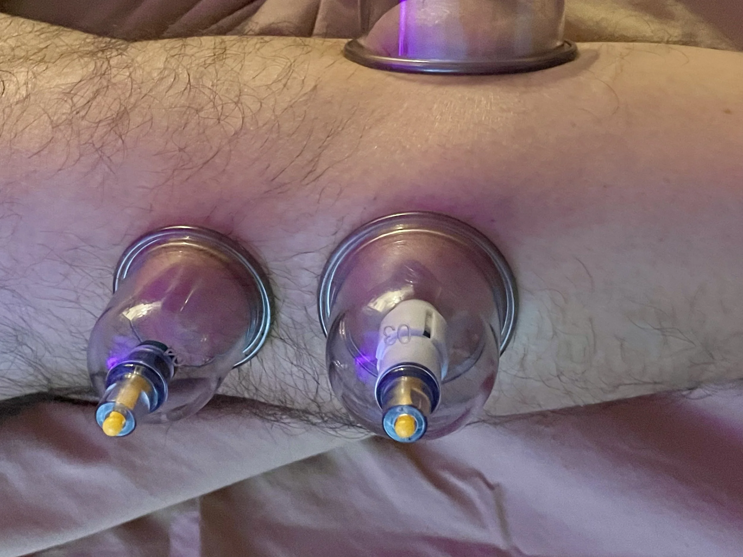 CUPPING WITH PLASTIC CUPS AND A PUMP