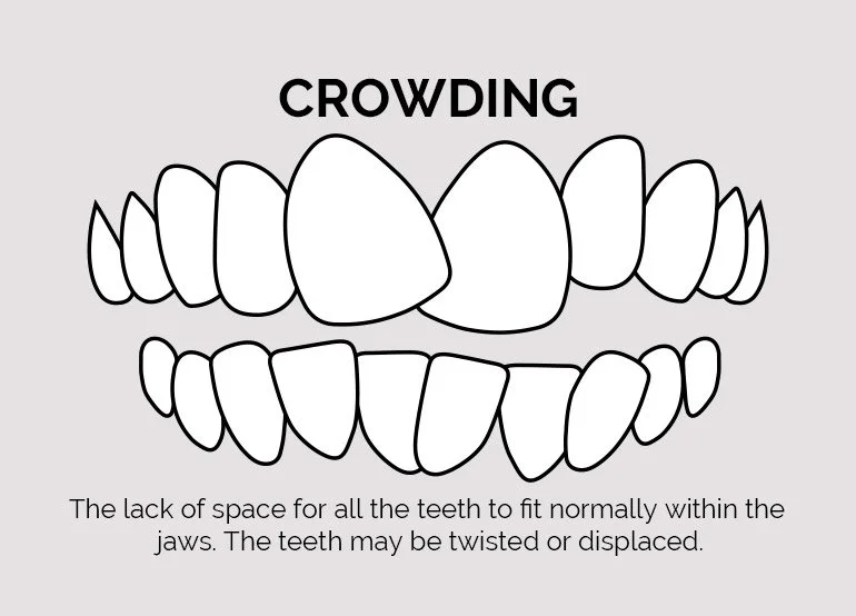 Crowding Teeth