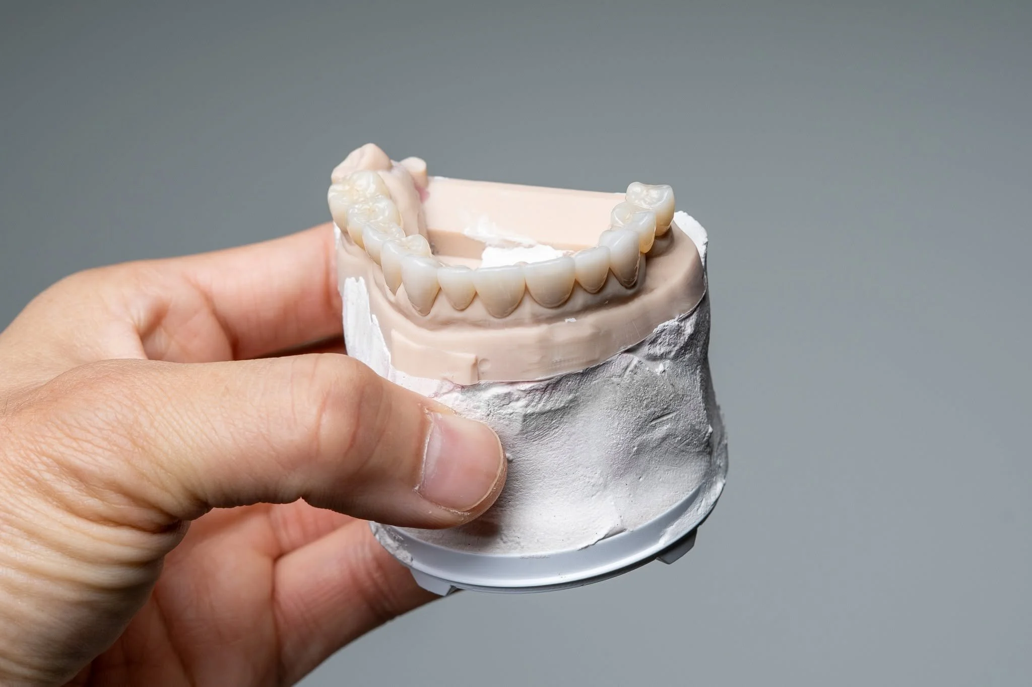 Full Upper Arch Crowns