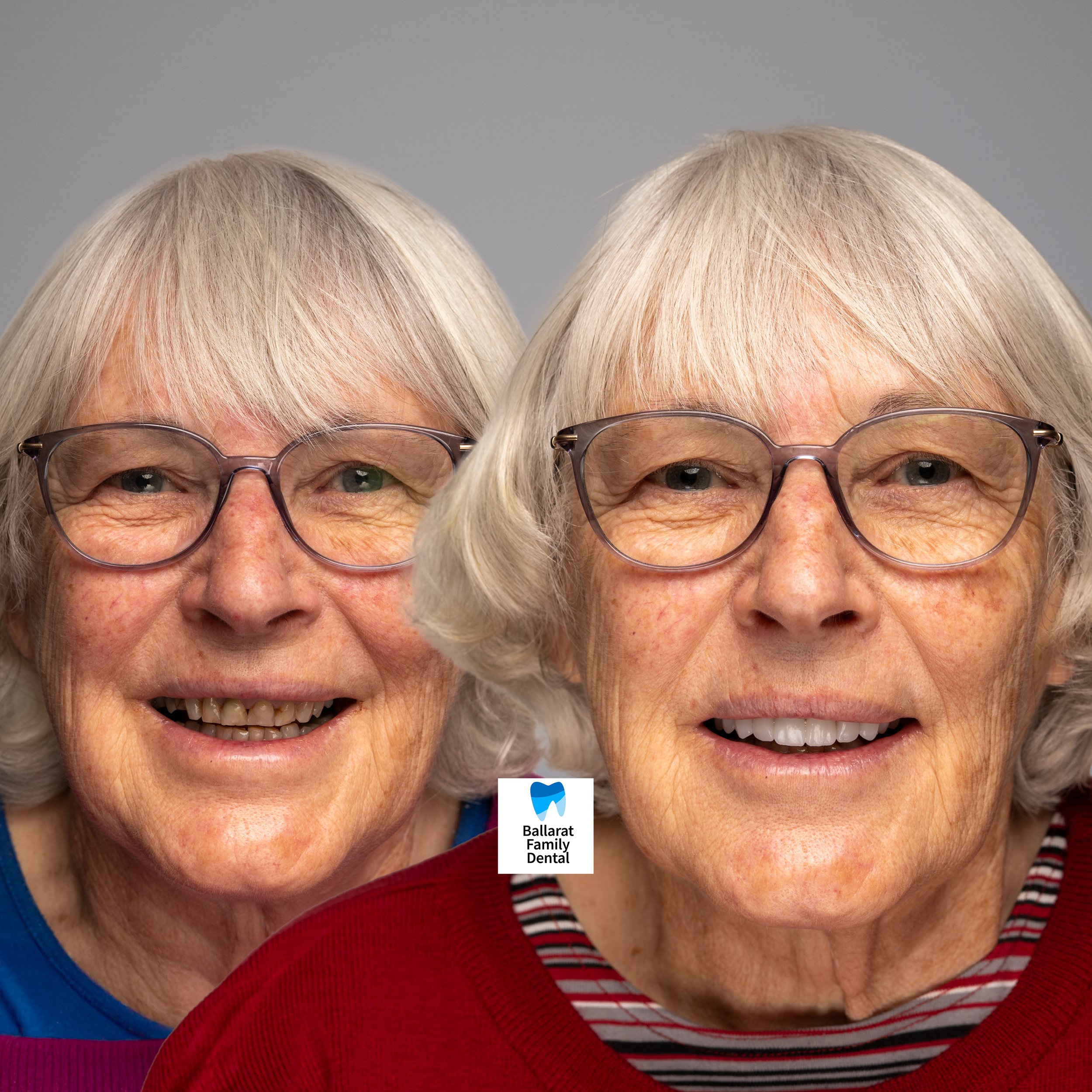 Treatment: Upper Arch Crowns