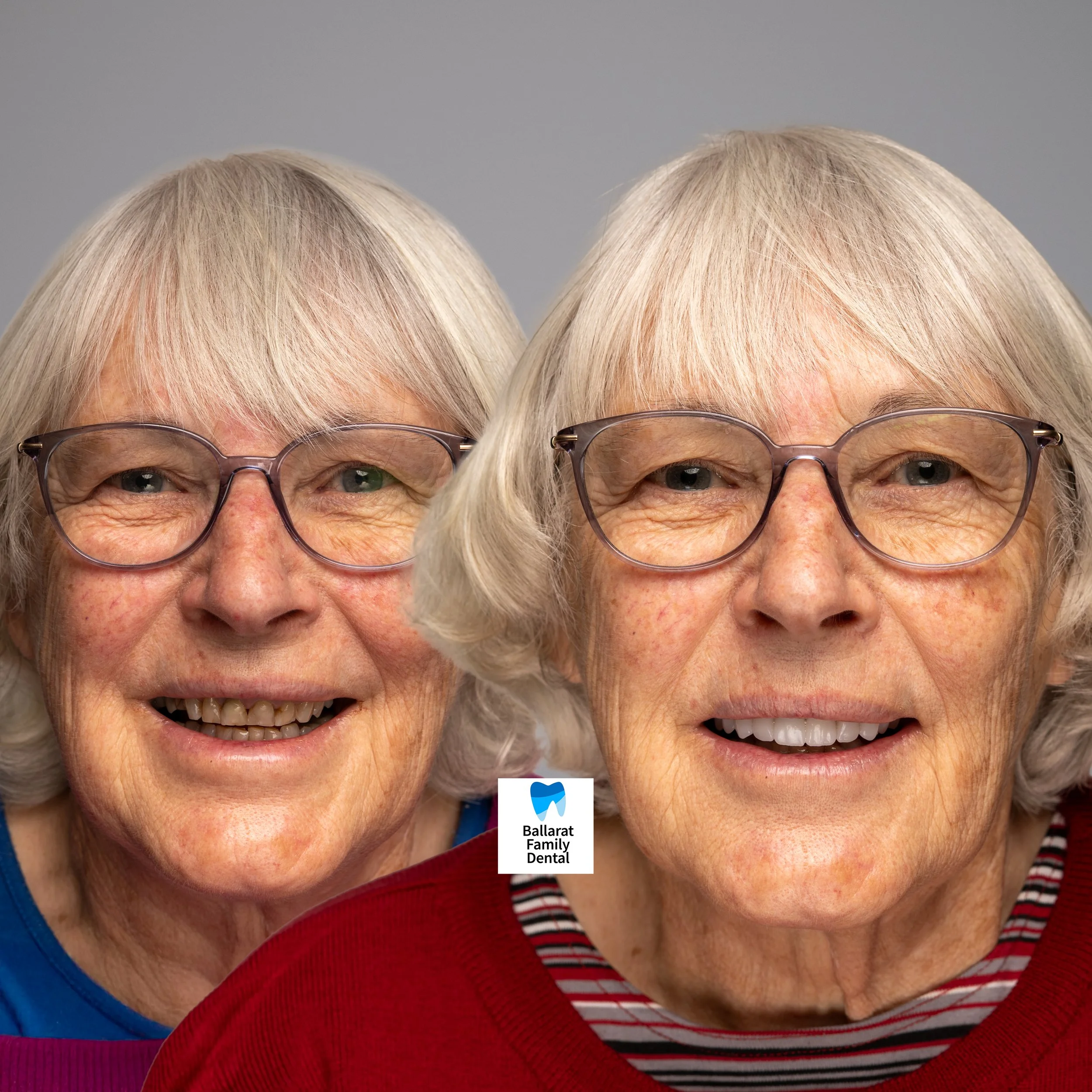 Treatment: Upper Arch Crowns