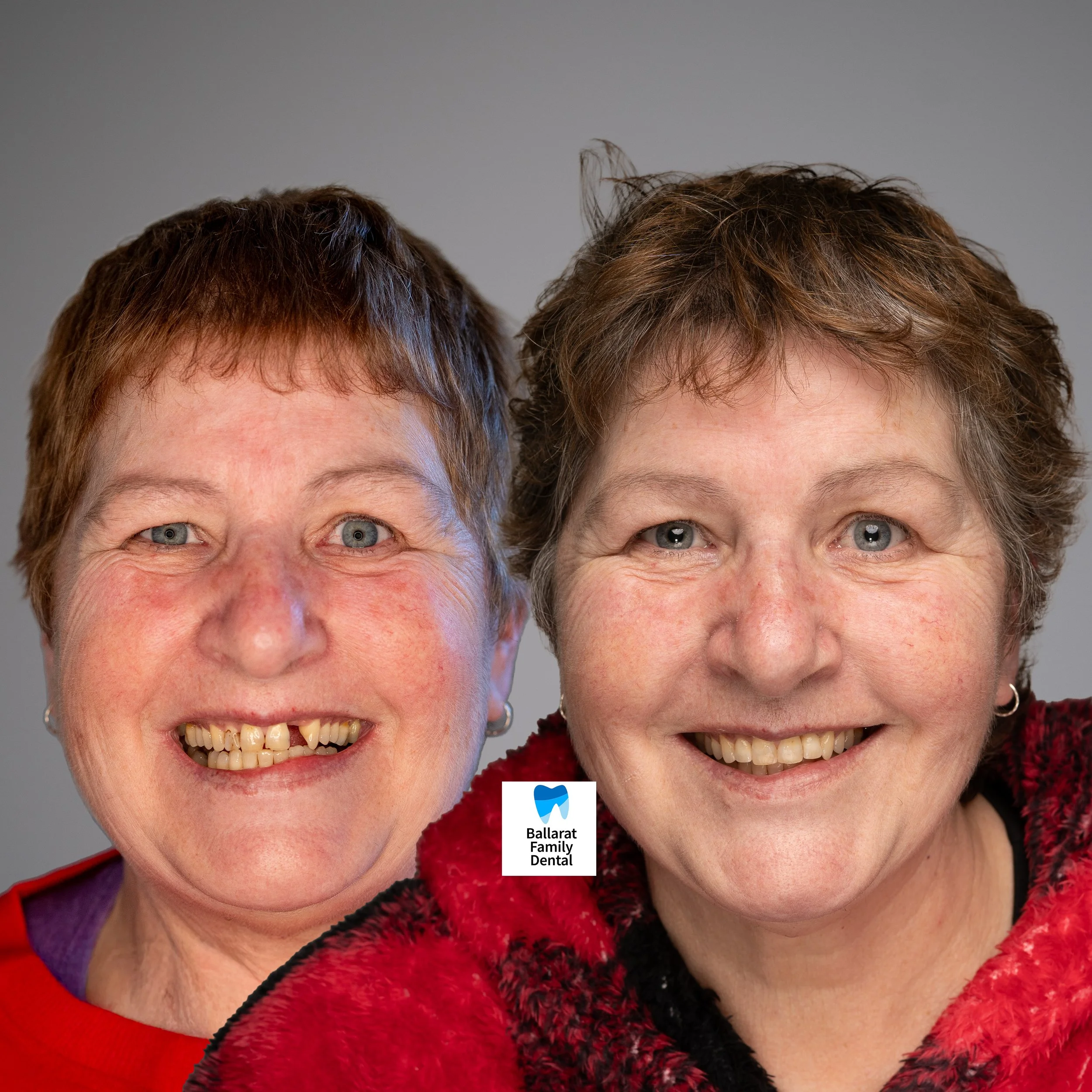 Before and After Picture of a Patient Who Had Front Teeth Fixed