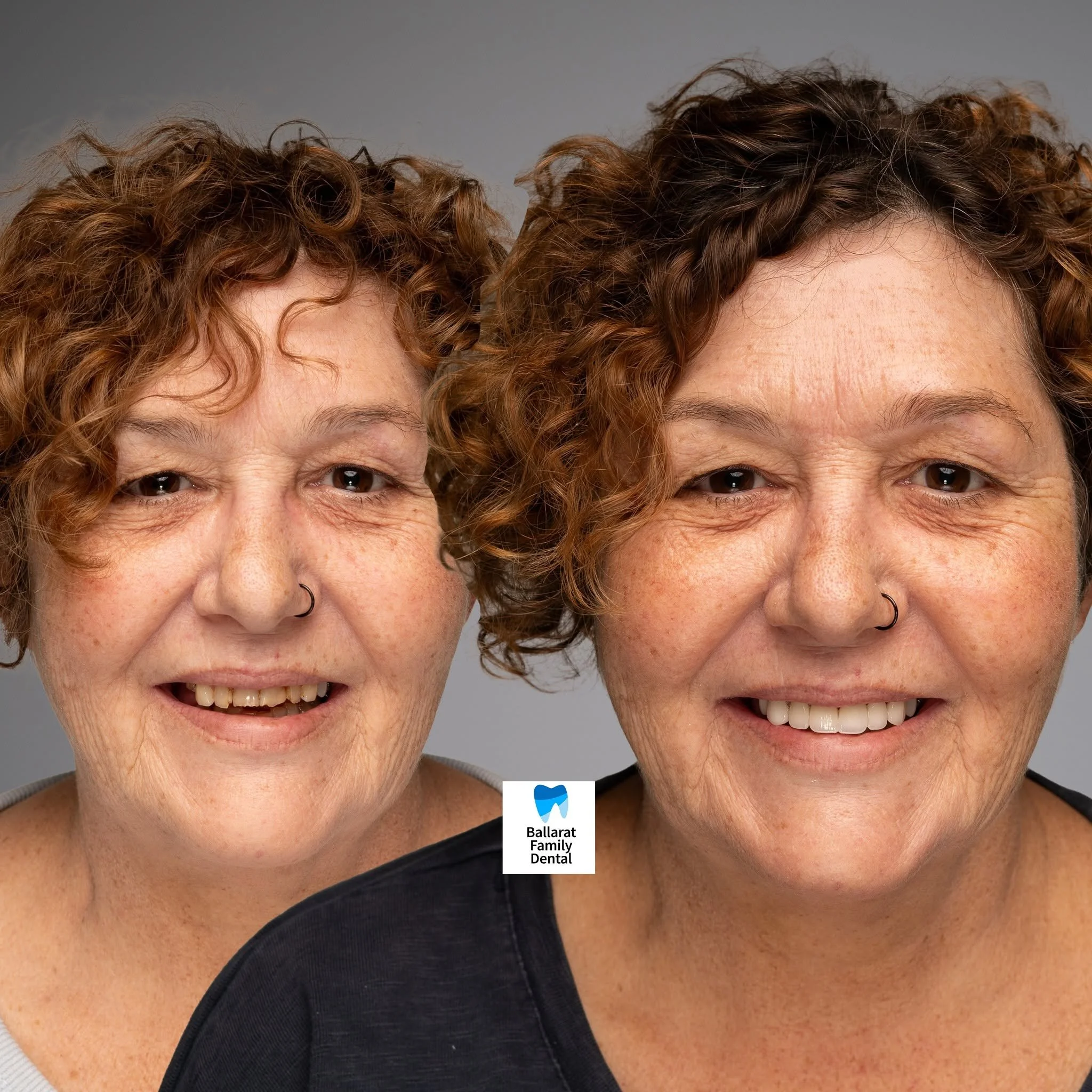 Treatment: Veneers