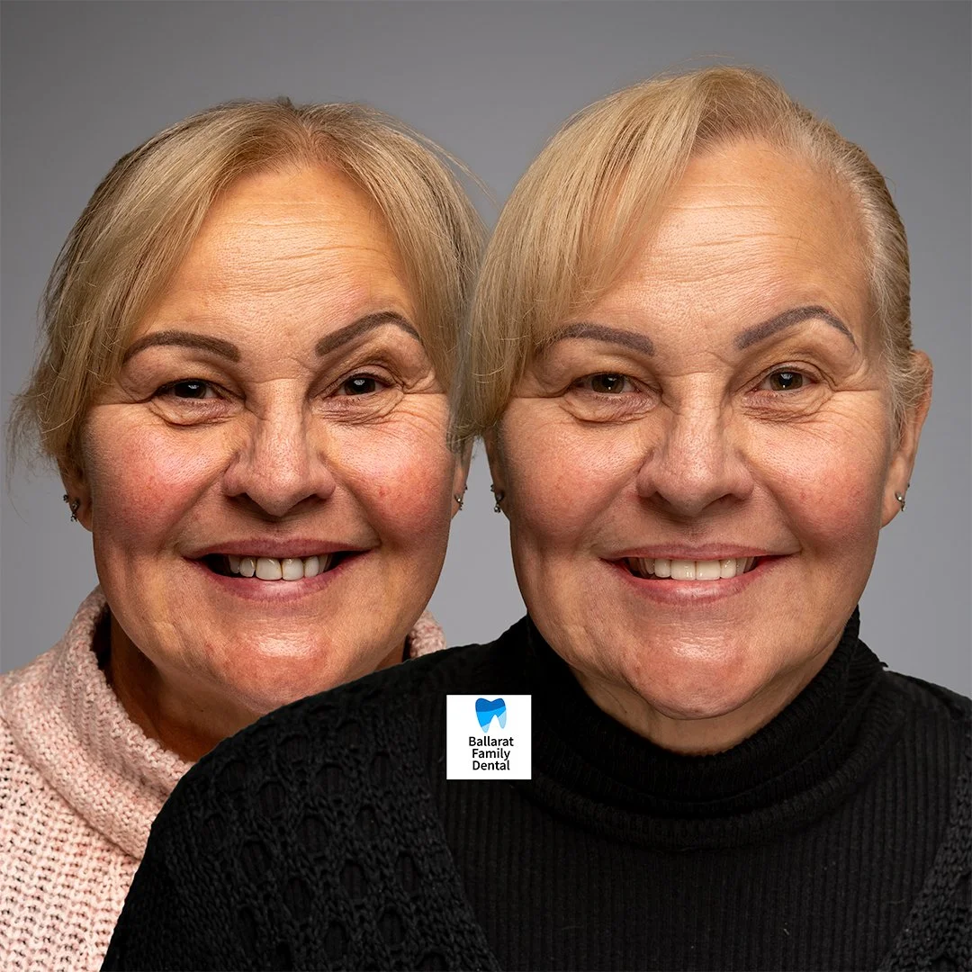 Treatment: Veneers