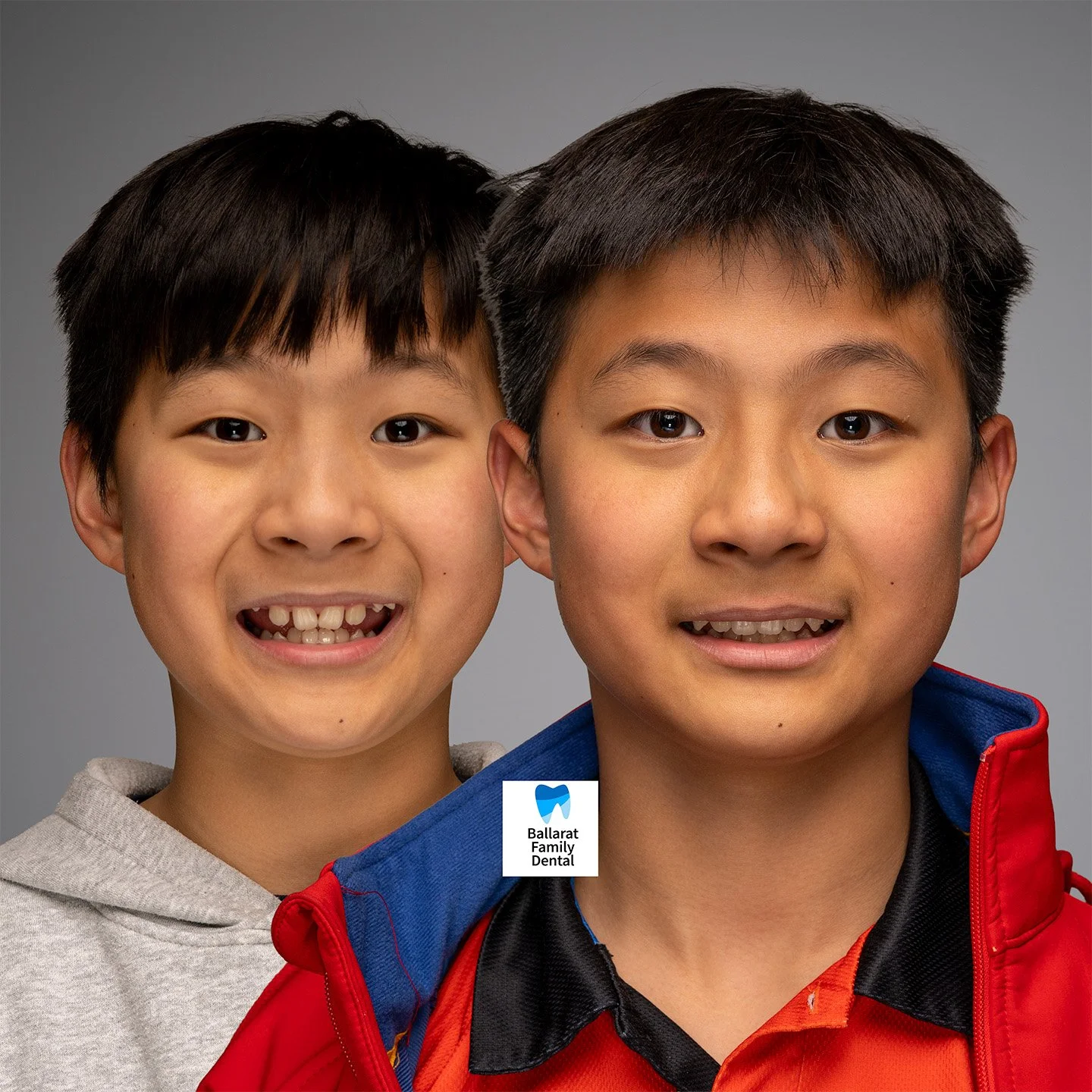 Treatment: Braces and Aligners