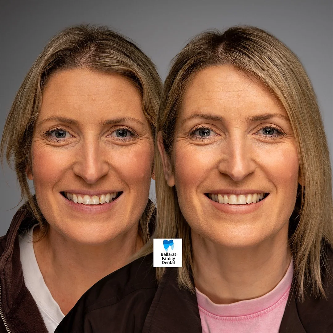 Treatment:  Icon and Fillings
