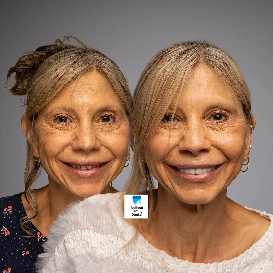 Treatment: Veneers