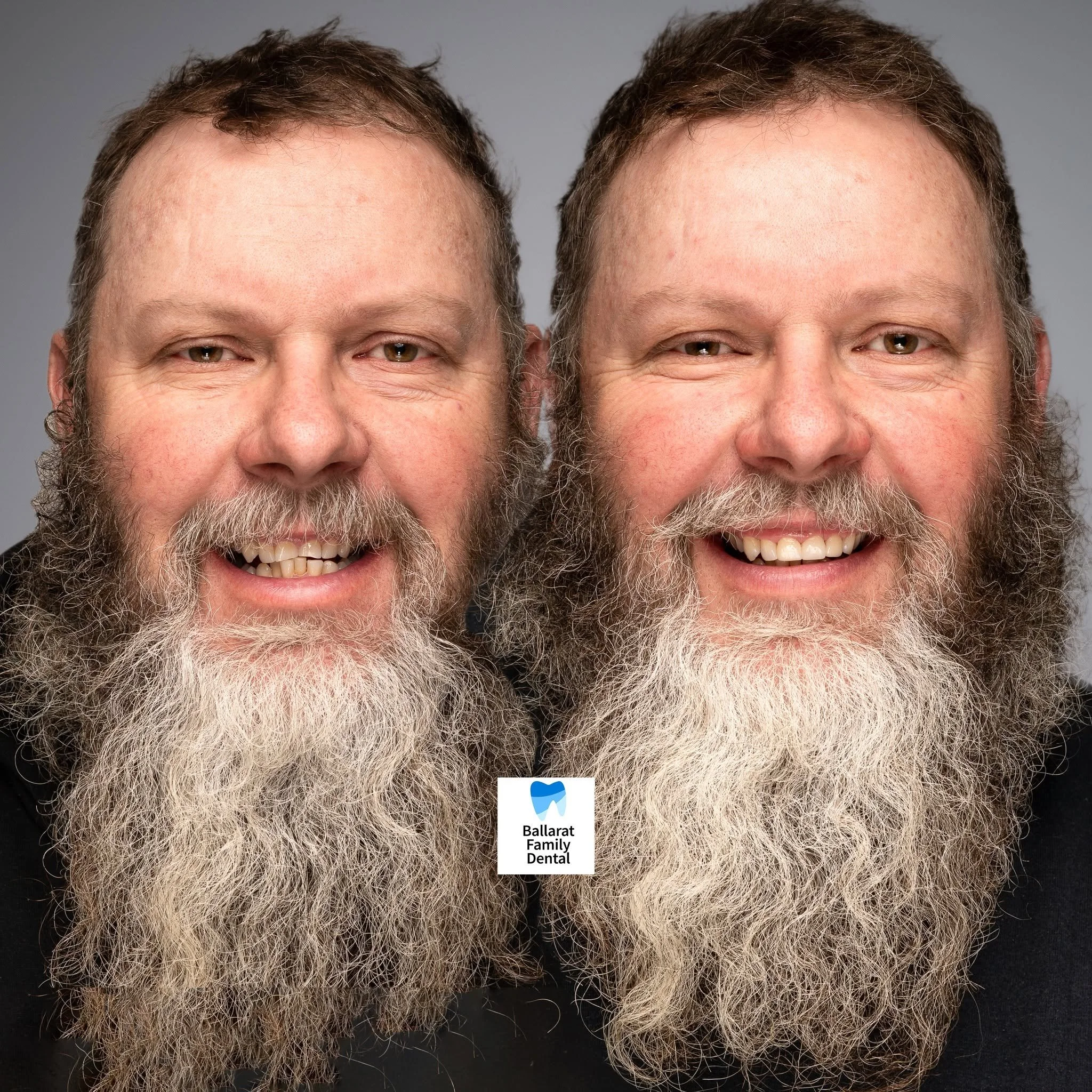 Treatment: Veneers