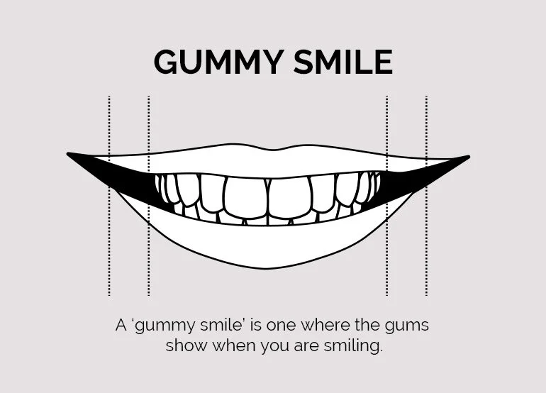 Gummy Smile