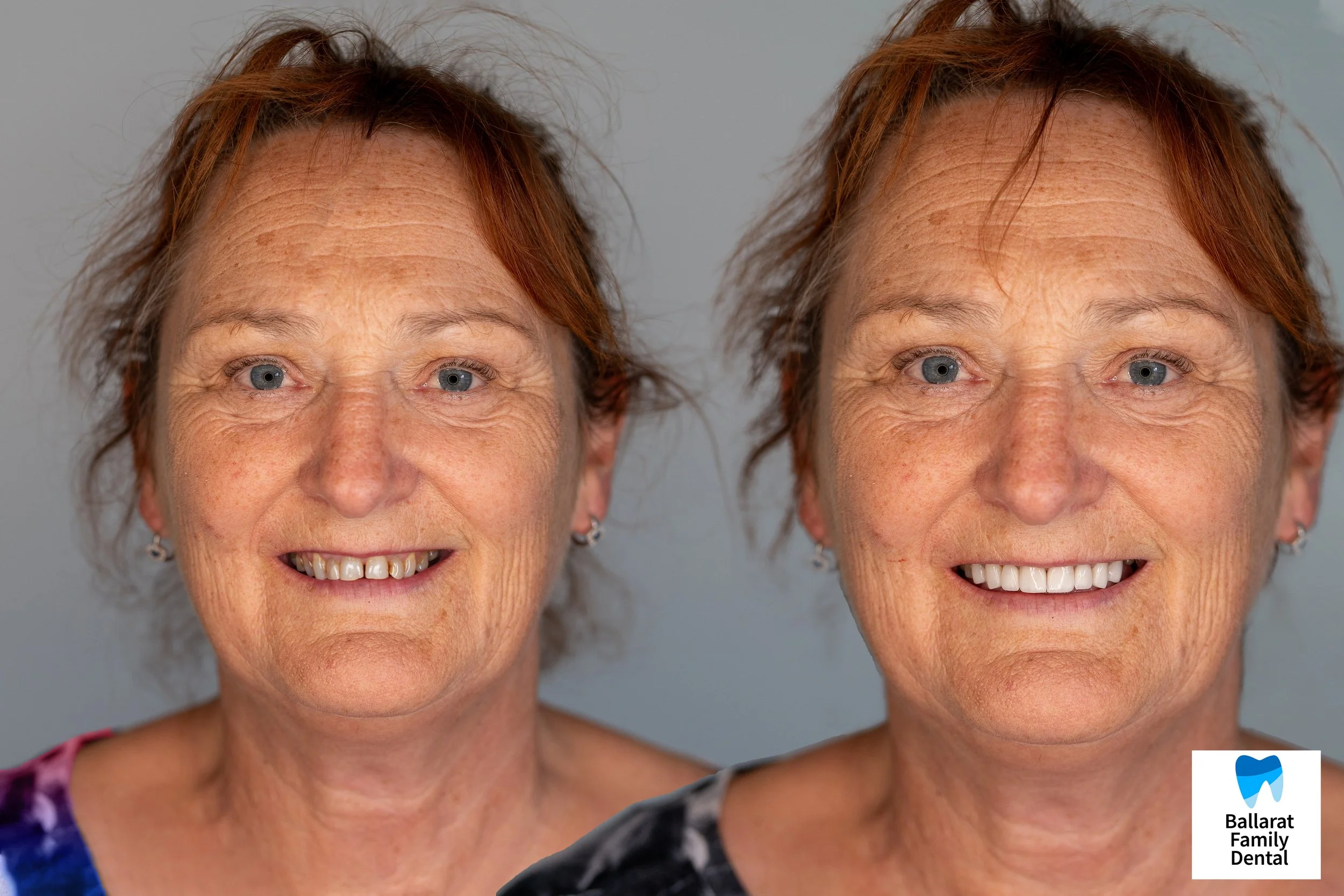 Side-by-side comparison of an elderly woman with red hair and blue eyes, showing her before and after dental work, smiling in both images, with the right image featuring a brighter, more even smile.