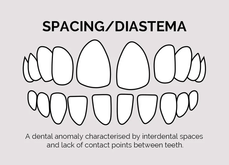 Spacing Diastema Teeth