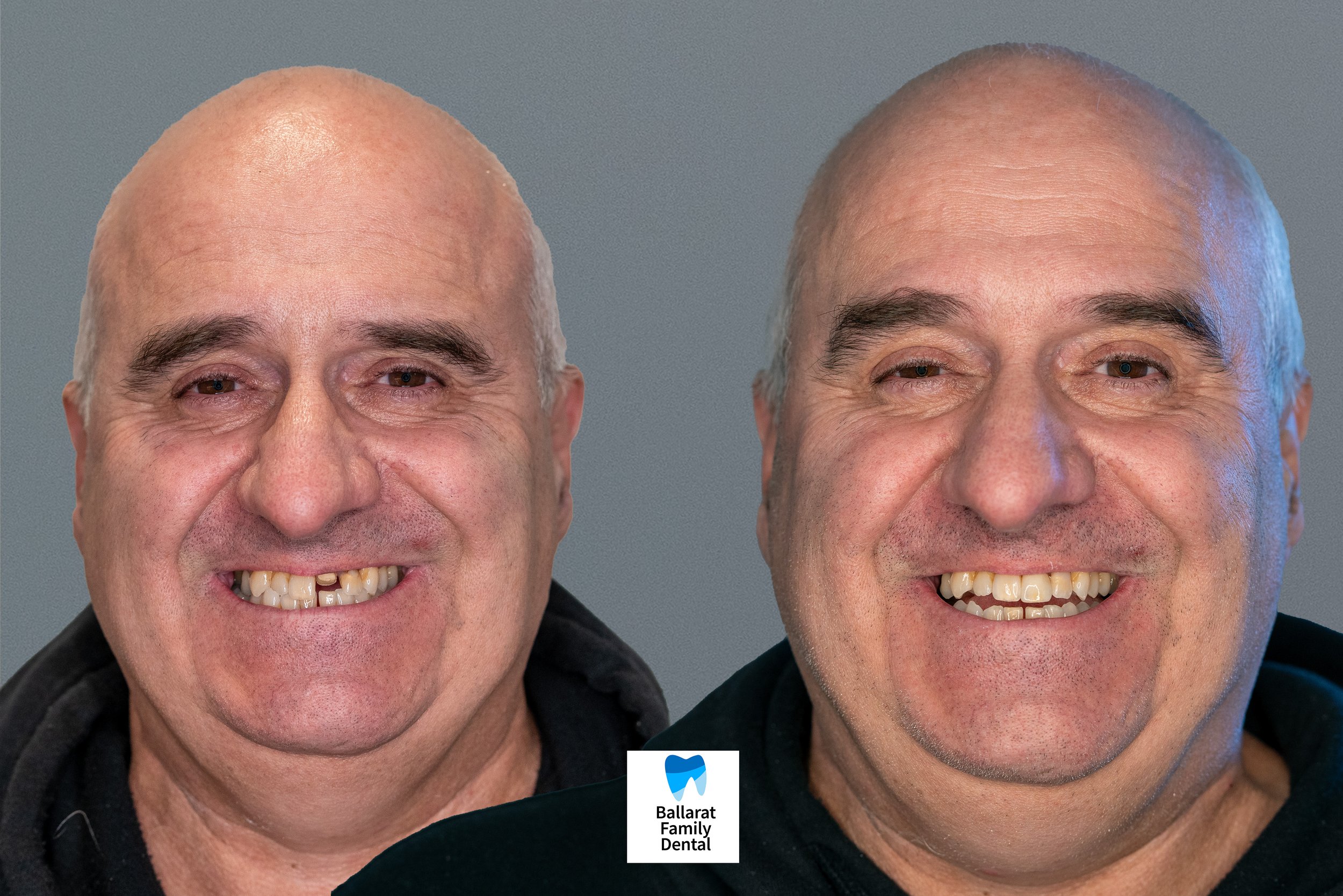 Front Tooth Crown at Ballarat Family Dental